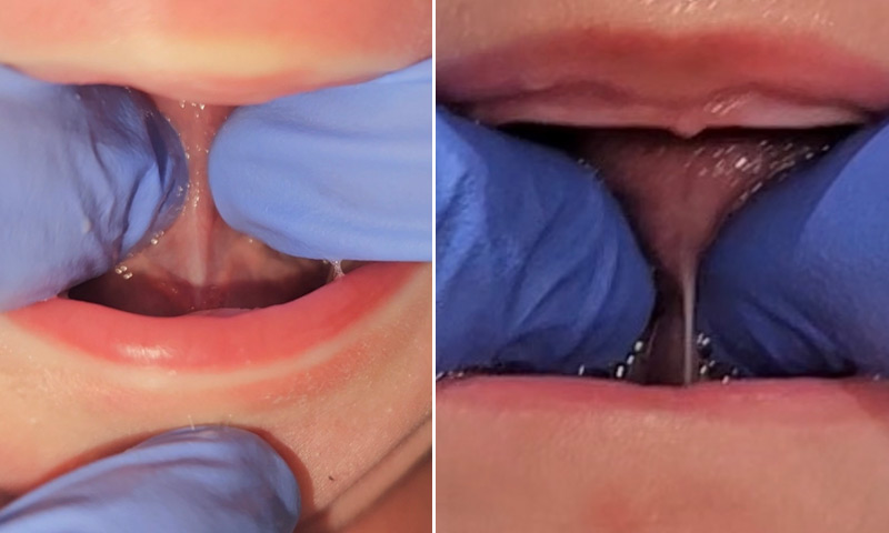 Tongue Tie Lip Tie Treatment (Frenectomy)  in Pinehurst