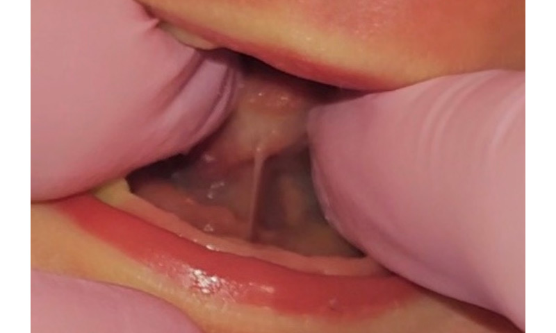Tongue Tie Lip Tie Treatment (Frenectomy)  in Pinehurst